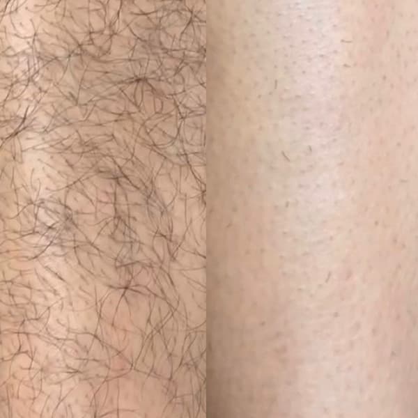 Évolution d'un traitement laser, suivi 2