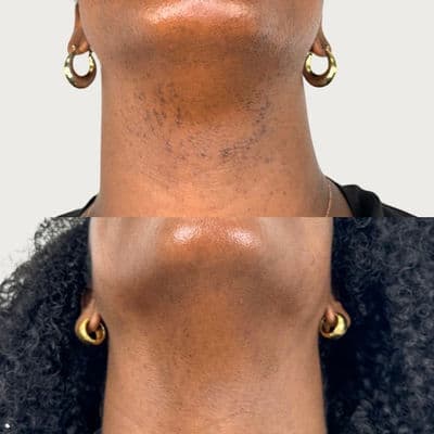 Évolution d'un traitement laser — suivi 3