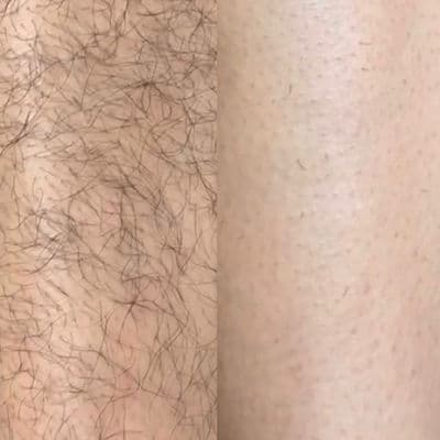 Évolution d'un traitement laser — suivi 2
