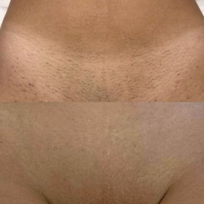 Évolution d'un traitement laser — suivi 1