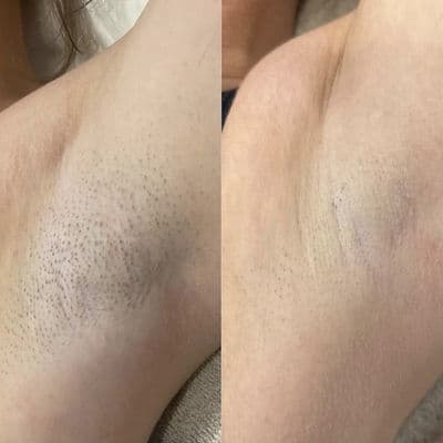 Évolution d'un traitement laser — suivi 4